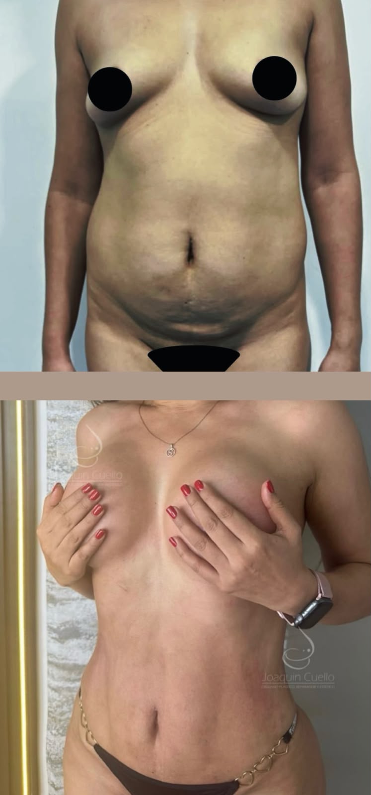 Antes y después — contorno corporal