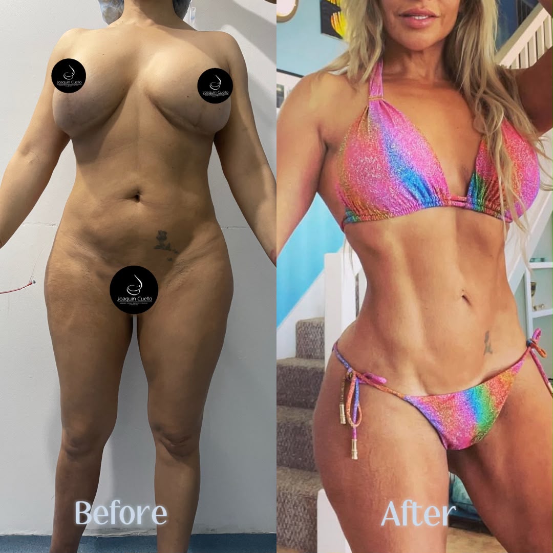 Antes y después — lipoescultura